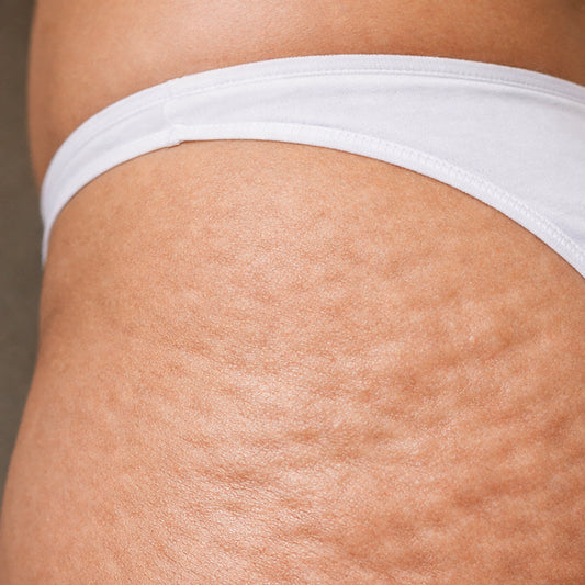 Cellulite Support Massage Blend | Aromatherapy Skin Care Us Them and U