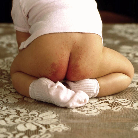 UsthemandU Children Mother and Baby Nappy Rash Cream UK based aromatherapy specialists  
